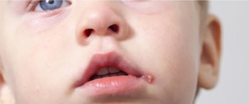 الهربس عند الأطفال